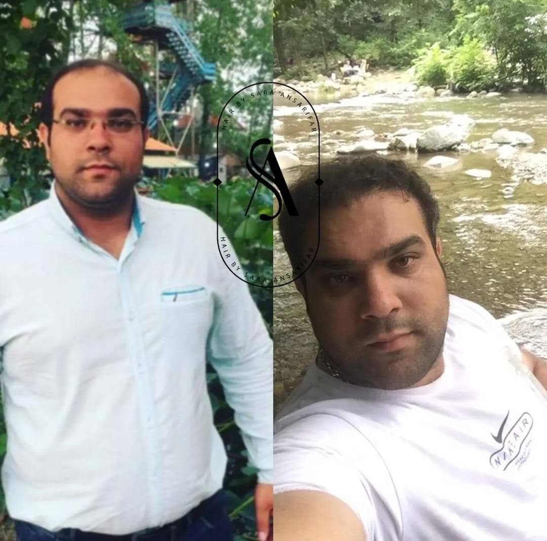 تحولی نوین در کاشت مو با سارا انصاریفر در شیراز